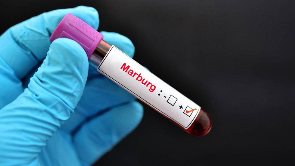 Marburg virusi asosan tibbiyot xodimlari orasida aniqlanmoqda